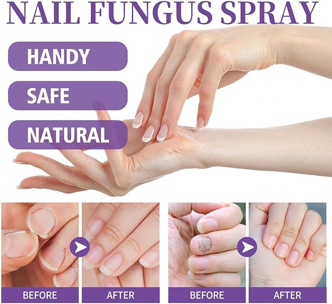 Powerful Antifungal Spray – Restore Your Nails Naturally