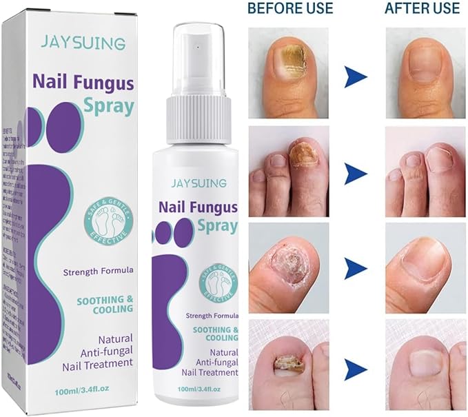 Powerful Antifungal Spray – Restore Your Nails Naturally