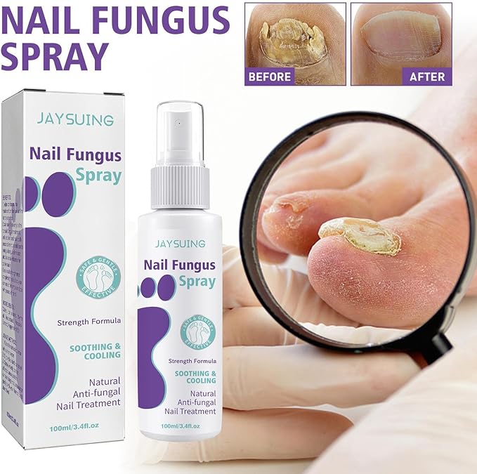 Powerful Antifungal Spray – Restore Your Nails Naturally