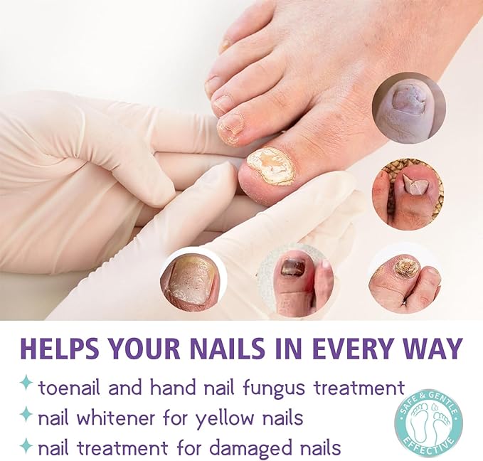 Powerful Antifungal Spray – Restore Your Nails Naturally